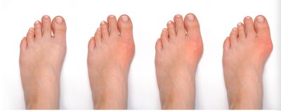 Bunions: What Causes Them? And What Can You Do About Them?
